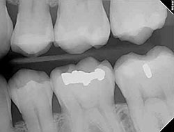 periodontitis